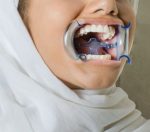 دهان بازکن و زبانگیر (رترکتور) قابل اتوکلاو SAM