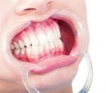 دهان بازکن نعلی مات قابل اتوکلاو (2عددی) COTISEN - Image 5