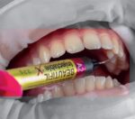 کامپوزیت فلو Shofu - Beautifil Injectable X - Image 8